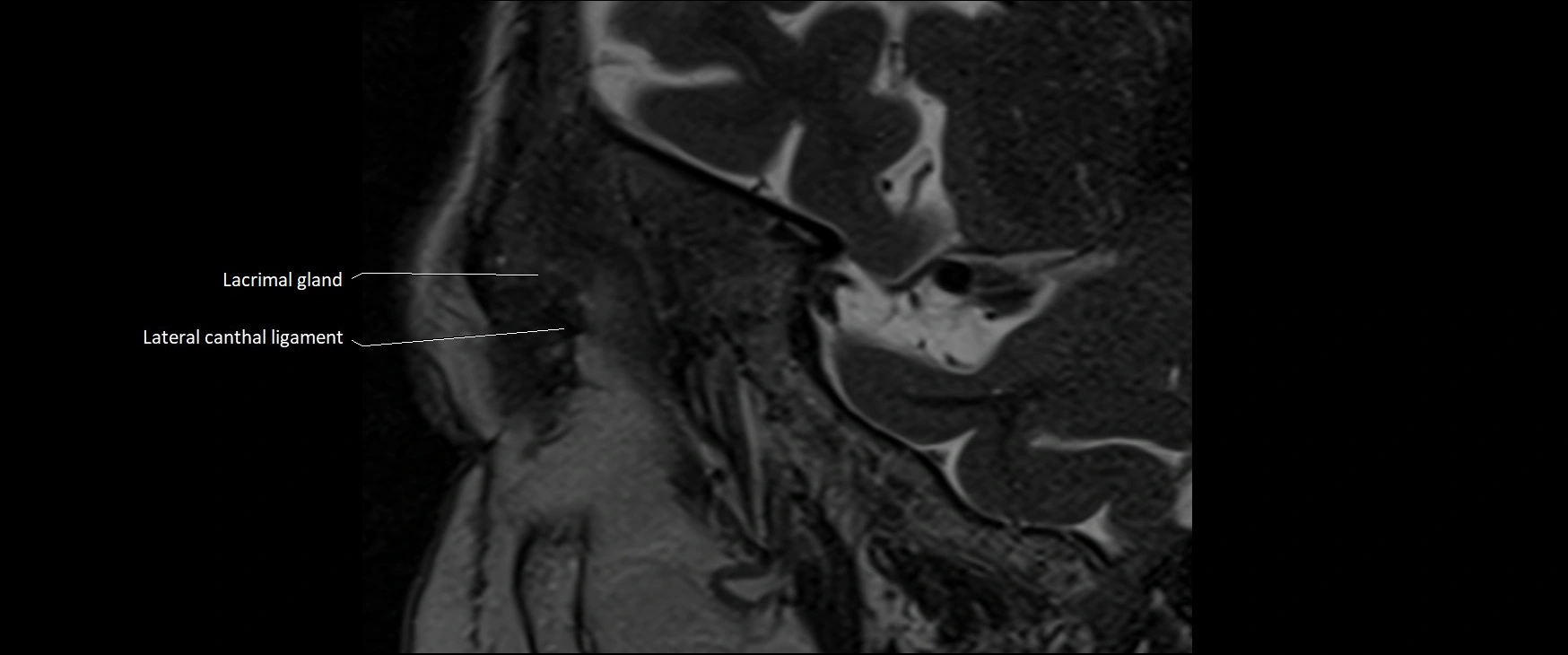 MRI Orbit sagittal cross sectional anatomy 3T image 17.webp